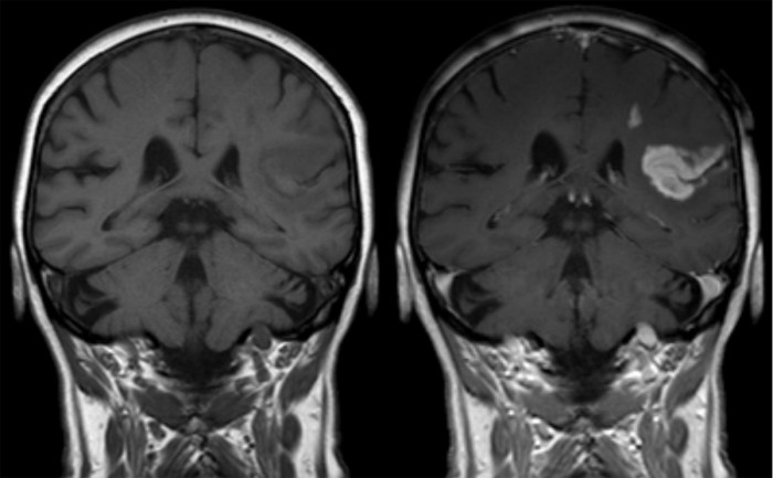 MRI of an ischemic stroke in the brain without (left) and with (right) contrast.