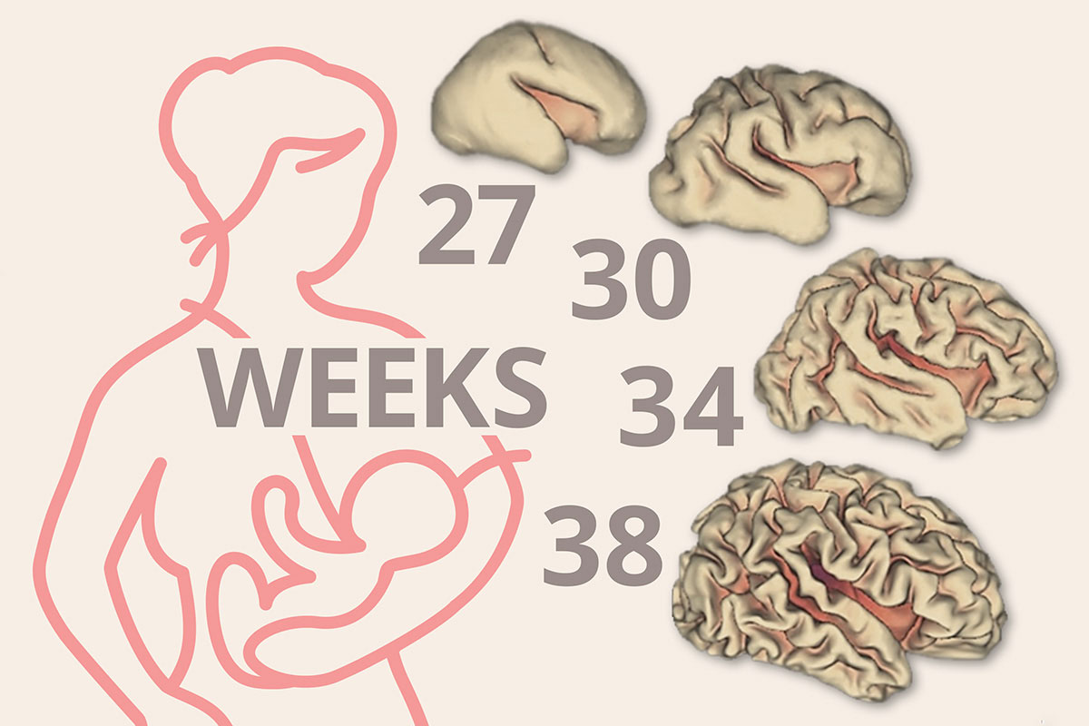 Because babies born prematurely are still developing, they typically have smaller brains than full-term infants. Shown are depictions of the cortical-surface area of the brain at different points in gestation.