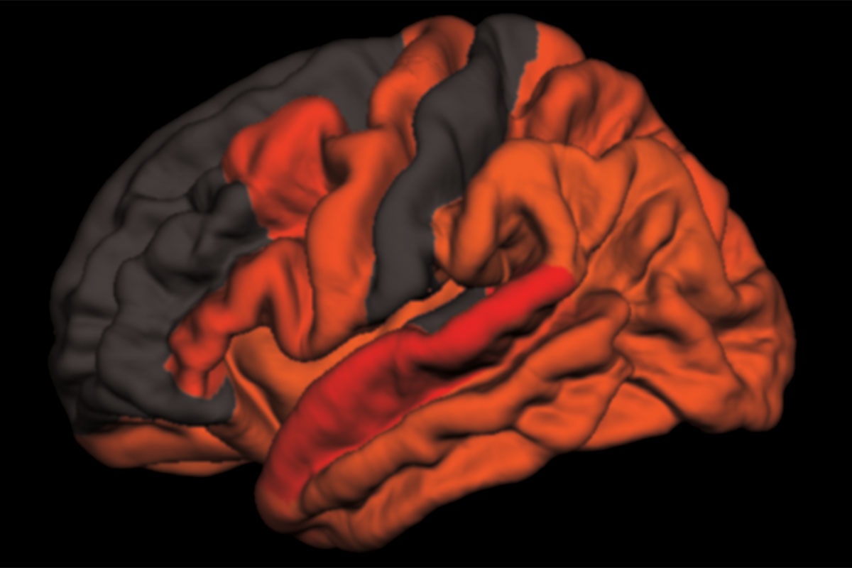 Decreased deep sleep linked to early signs of Alzheimer's disease