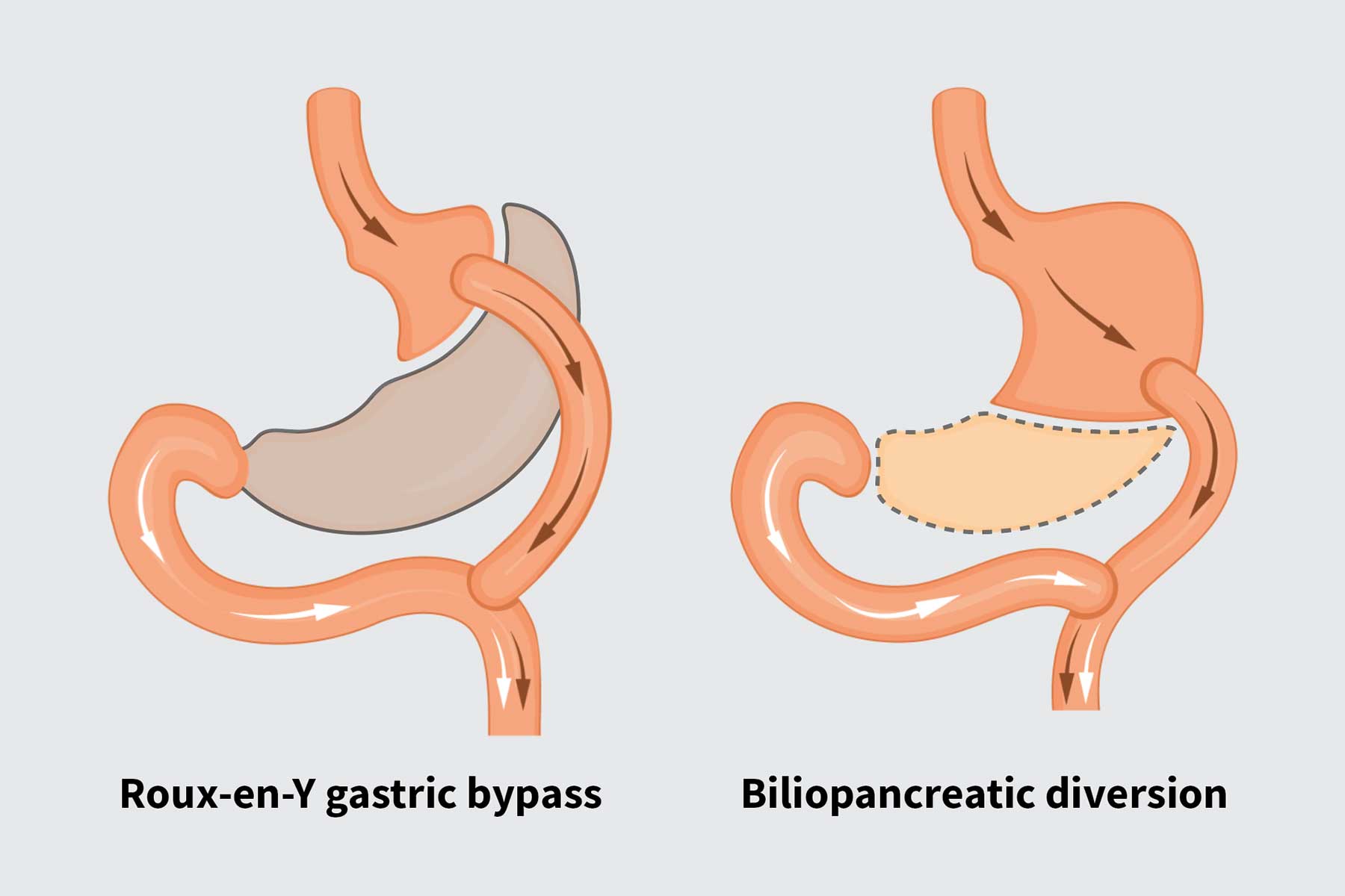 Uncommon weight loss surgery best for reducing diabetes risk ...