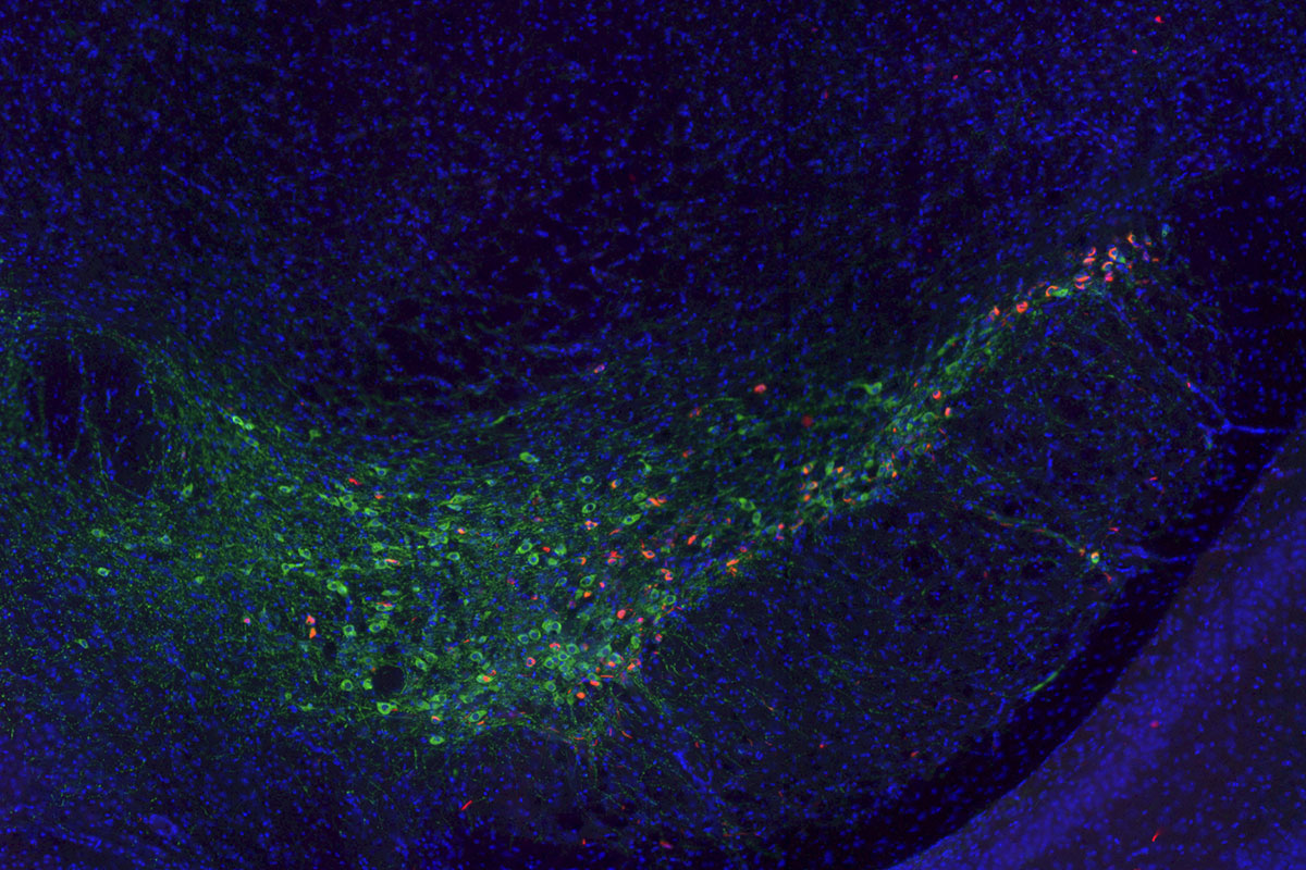 Gene ID'd as potential therapeutic target for dementia in