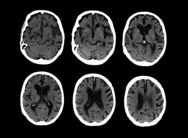 C.T. scans of the brain of a 74-year-old with Alzheimer’s disease