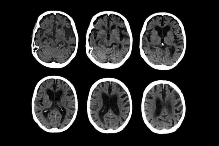 C.T. scans of the brain of a 74-year-old with Alzheimer’s disease