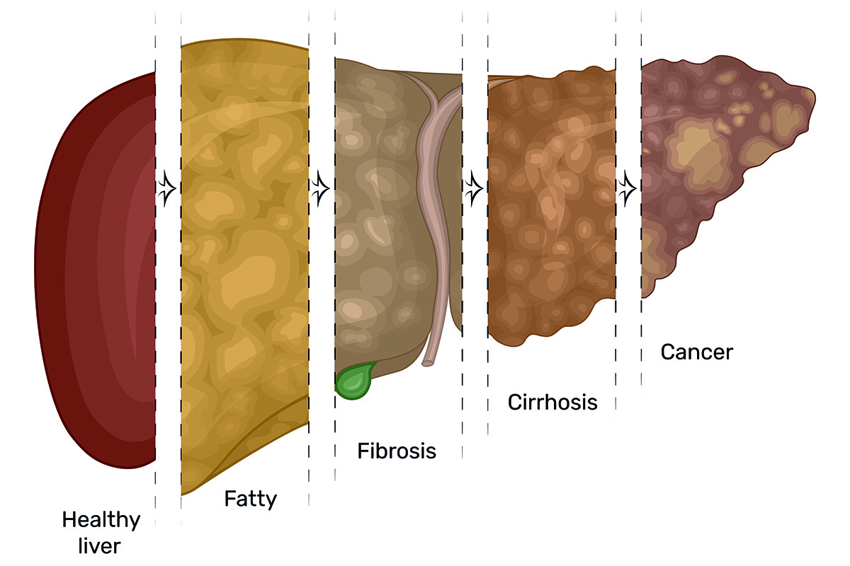 Study reveals links between fatty liver disease, liver cancer ...