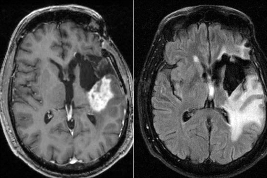 glutathione help with chemo brain for glioblastoma may work better in morning than evening – WashU Medicine Biocyte Glutathion Liposomal 30 De-Pigmenting Agents Super Smoother Blurring Skin Tint (Colour):Warm Medium