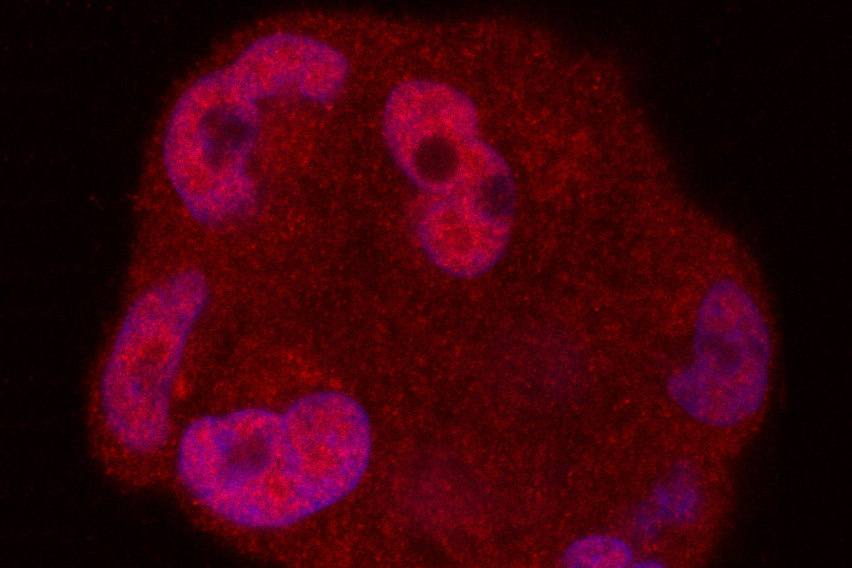New strategy against treatment-resistant prostate cancer
