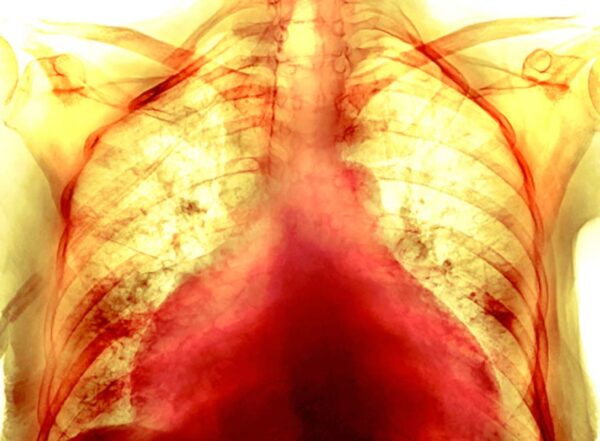 Colored chest x-ray of the enlarged heart of a 74-year-old female COVID-19 patient