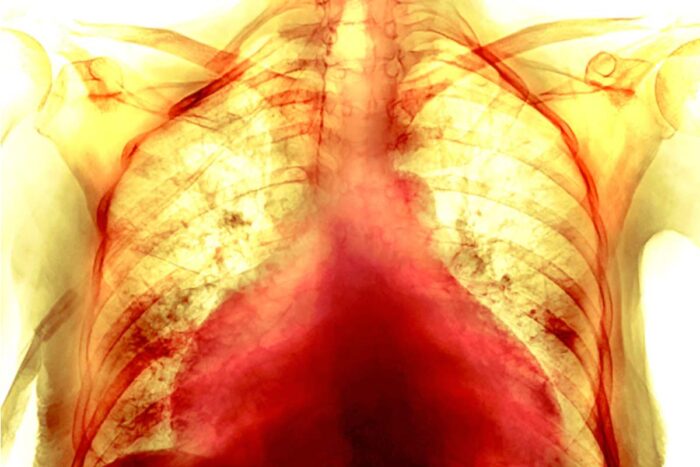 Colored chest x-ray of the enlarged heart of a 74-year-old female COVID-19 patient