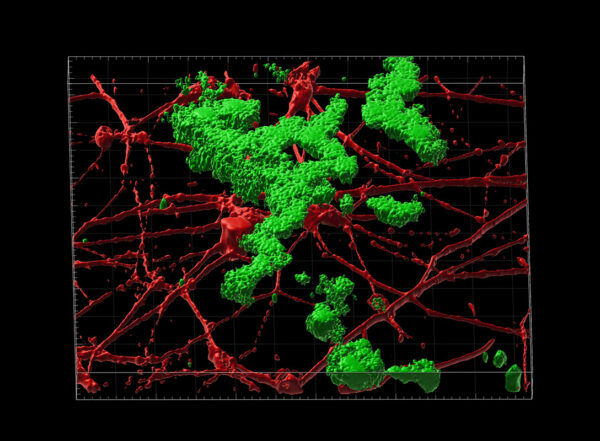 Shown is a 3D reconstruction of amyloid beta plaque deposition (green) between neurons (red) grown in the lab. These neurons were transformed from human skin cells taken from patients with late-onset Alzheimer's disease.