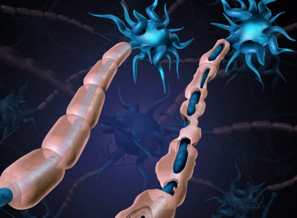 A healthy neuron next to one damaged by multiple sclerosis