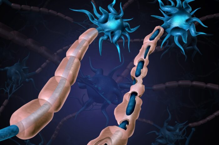 A healthy neuron next to one damaged by multiple sclerosis