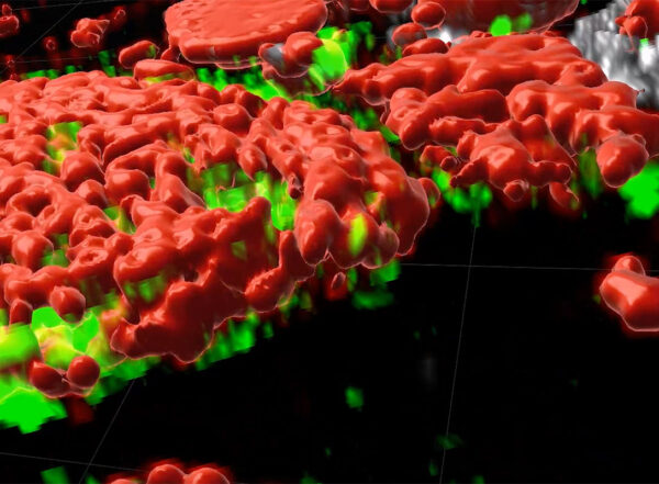 3D visualization of a breast tumor