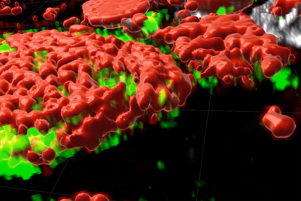 3D visualization of a breast tumor