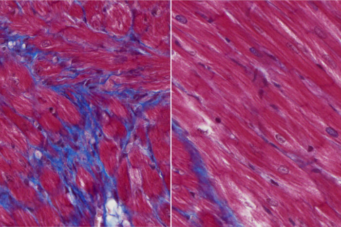 Cardiac tissue from mouse models of heart failure treated with a monoclonal antibody show much less scarring than untreated animals