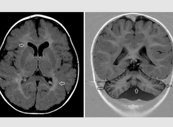 brain scans of patient with brain malformations