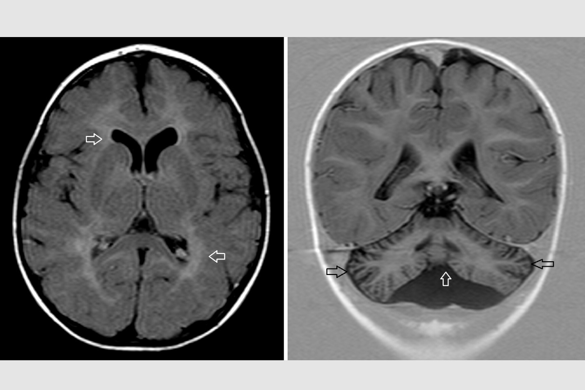 brain scans of patient with brain malformations