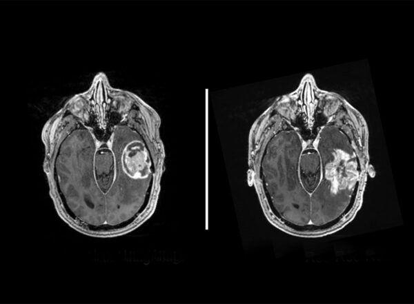 Brain scans of a patient with glioblastoma at initial diagnosis (left) and the same patient with a recurrent tumor after treatment (right).