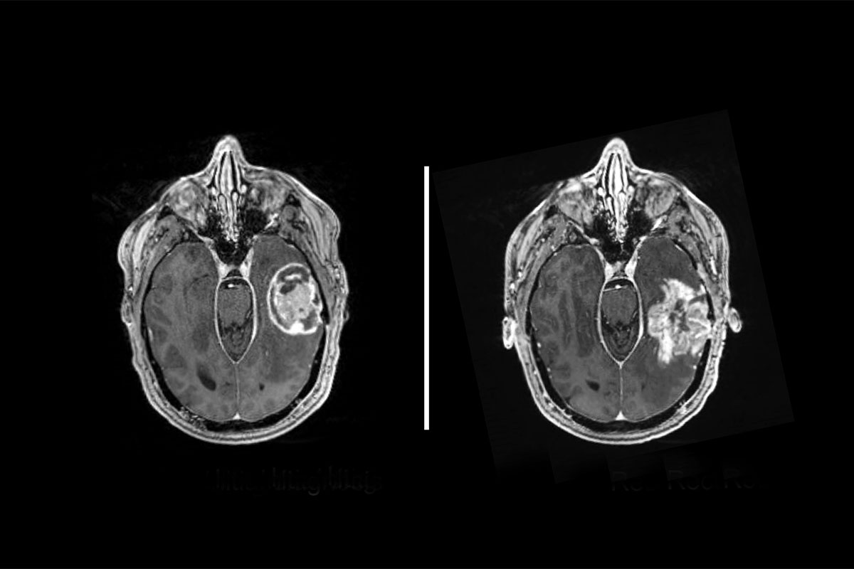 Brain scans of a patient with glioblastoma at initial diagnosis (left) and the same patient with a recurrent tumor after treatment (right).