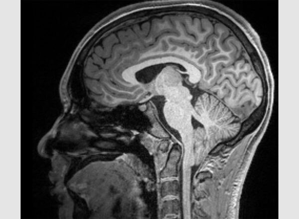 Chiari type-1 brain scan