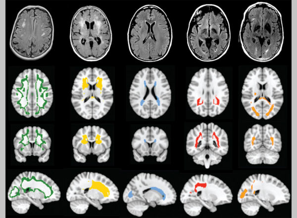 Brain scans with different patterns of white matter hyperintensitivies presented from different perspectives.