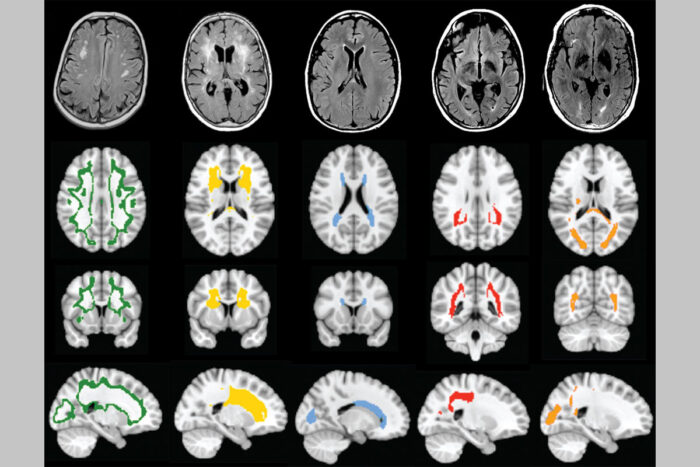 Brain scans with different patterns of white matter hyperintensitivies presented from different perspectives.