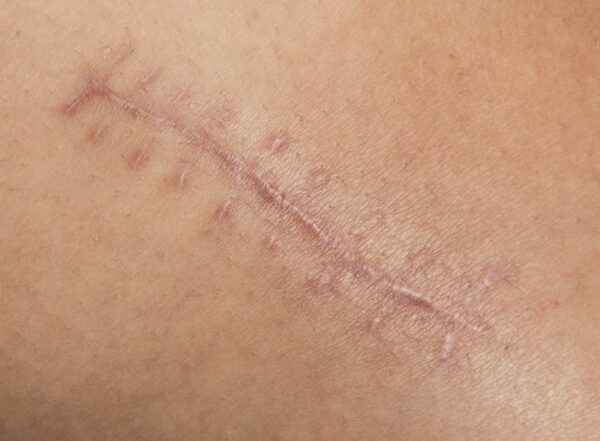 a scar left after surgery