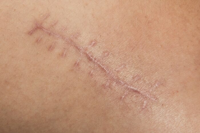 a scar left after surgery