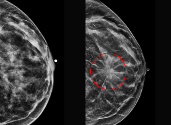 Mammograms with breast cancer circled in red