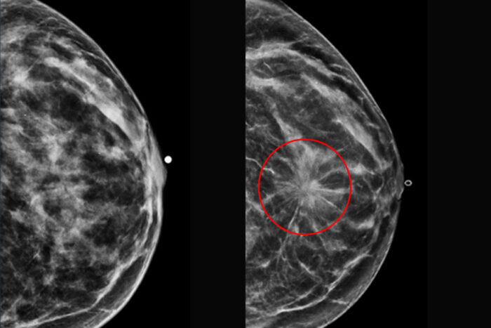 Mammograms with breast cancer circled in red