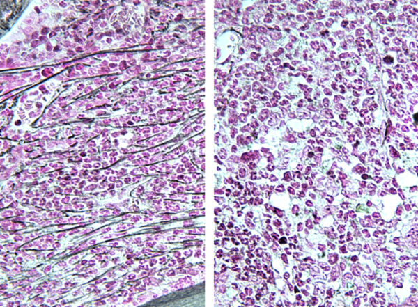 The bone marrow of a mouse with a myeloproliferative neoplasm (left) shows fibrosis, or scar tissue (horizontal lines). A mouse with the same disease treated with an RSK1 inhibitor shows bone marrow resembling normal (right).