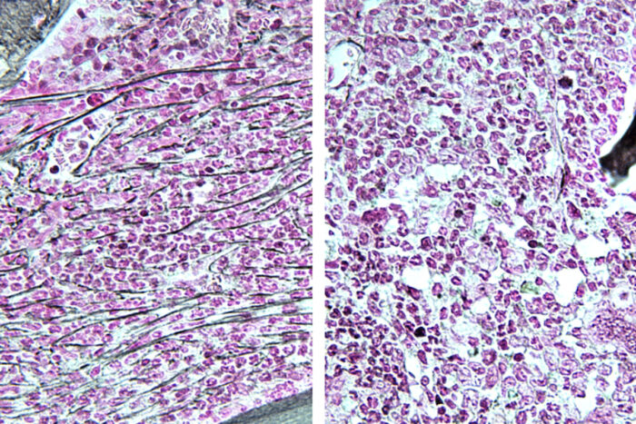 The bone marrow of a mouse with a myeloproliferative neoplasm (left) shows fibrosis, or scar tissue (horizontal lines). A mouse with the same disease treated with an RSK1 inhibitor shows bone marrow resembling normal (right).