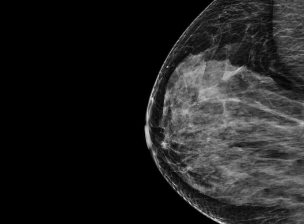 Mammography scan of a breast shown in black and white