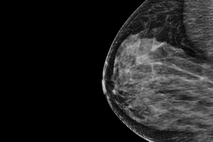 Mammography scan of a breast shown in black and white