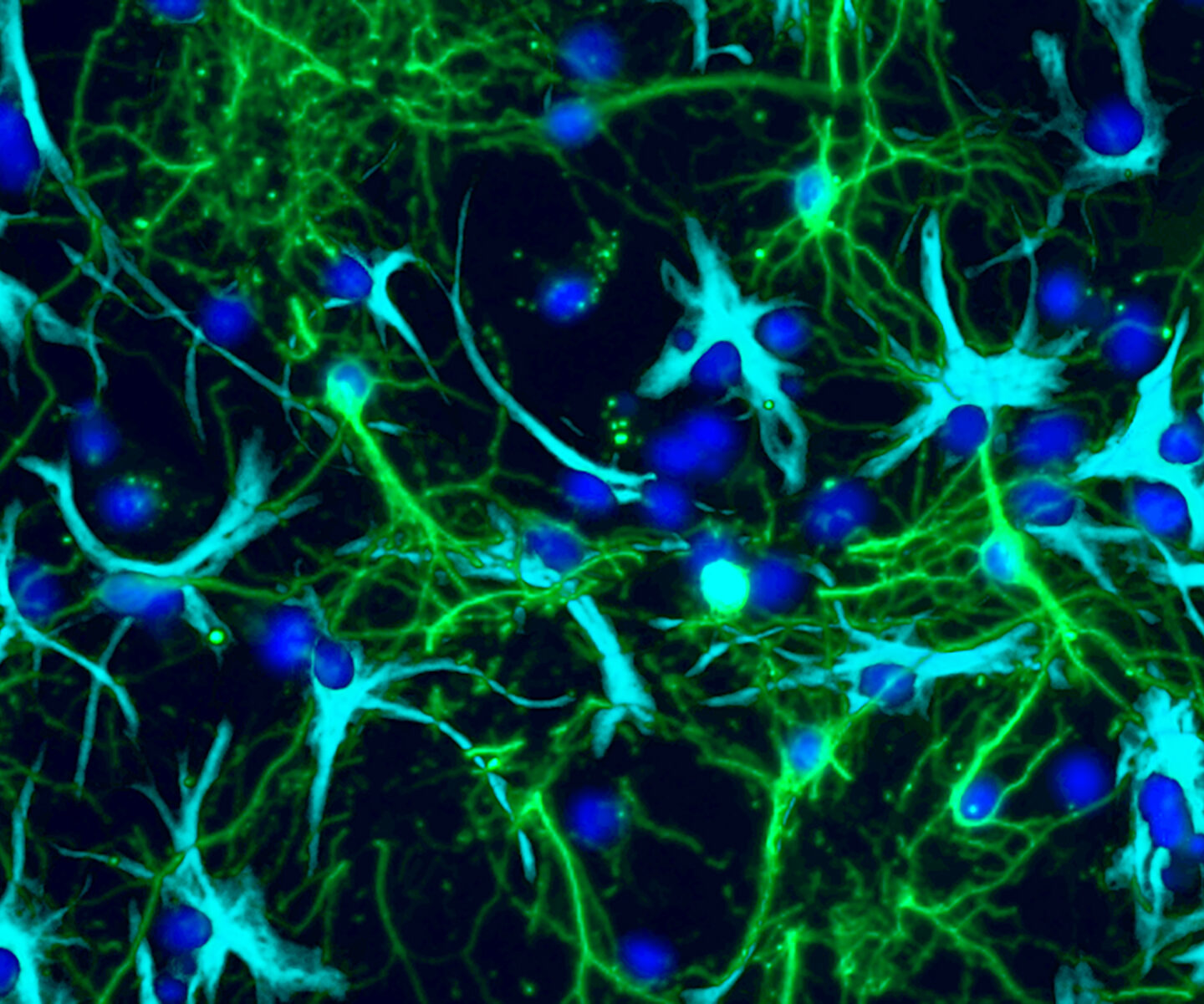 Tumor cells grown in a lab are shown interconnected with nerve cells in the brain.