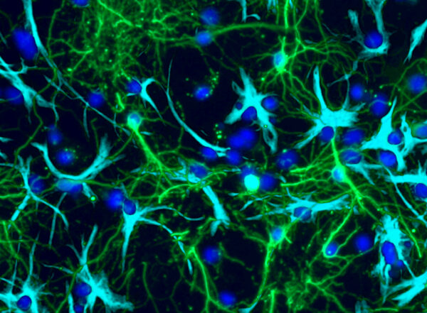 Tumor cells grown in a lab are shown interconnected with nerve cells in the brain.