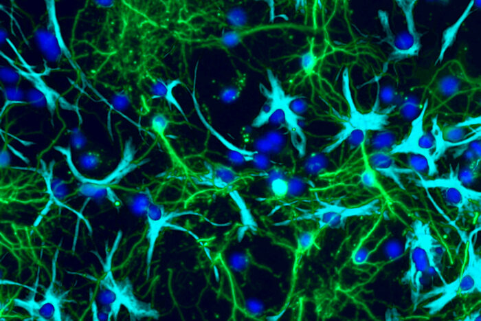 Tumor cells grown in a lab are shown interconnected with nerve cells in the brain.