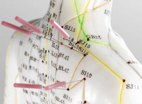 female acupuncture model with needles in the shoulder