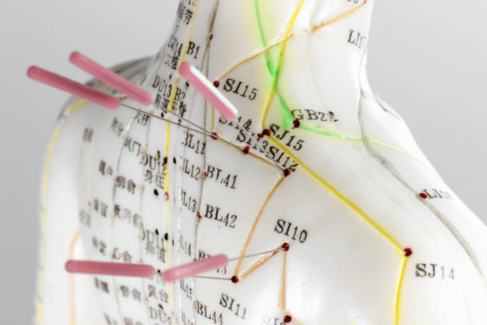 female acupuncture model with needles in the shoulder