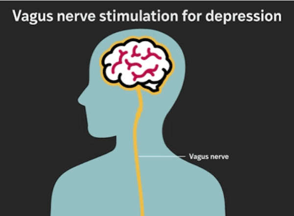 An animation of a small implanted device under the skin in the chest that emits carefully calibrated electrical pulses to the left vagus nerve — a major conduit between the brain and internal organs.