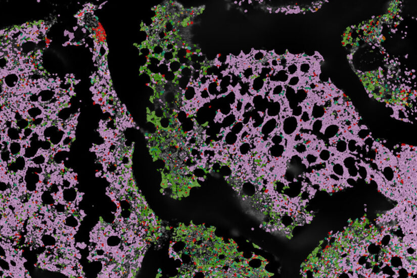 Inflammatory immune cells predict survival, relapse in multiple myeloma ...