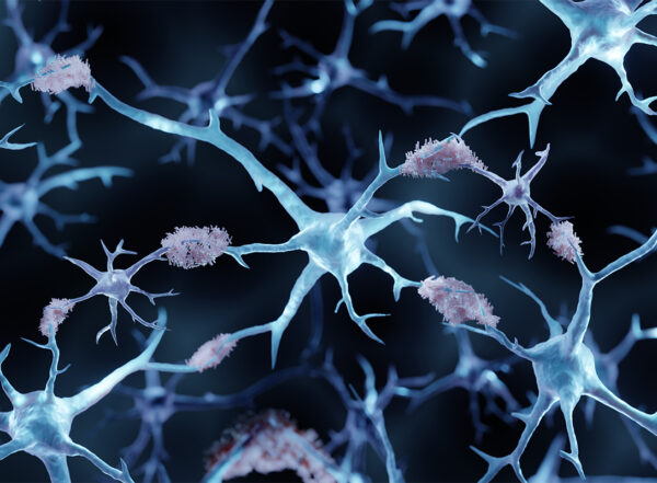 3d illustration showing amyloid plaques in Alzheimer's disease