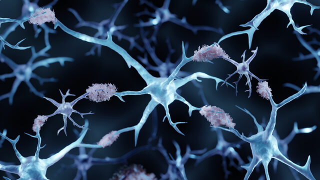 3d illustration showing amyloid plaques in Alzheimer's disease