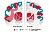 An illustration of the connections between the somato-cognitive action network (SCAN) and the motor cortex in the brain of a healthy person (right) compared with a person with Parkinson's disease.