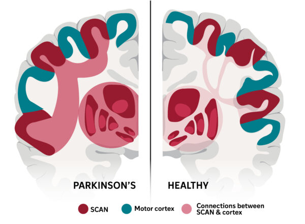An illustration of the connections between the somato-cognitive action network (SCAN) and the motor cortex in the brain of a healthy person (right) compared with a person with Parkinson's disease.