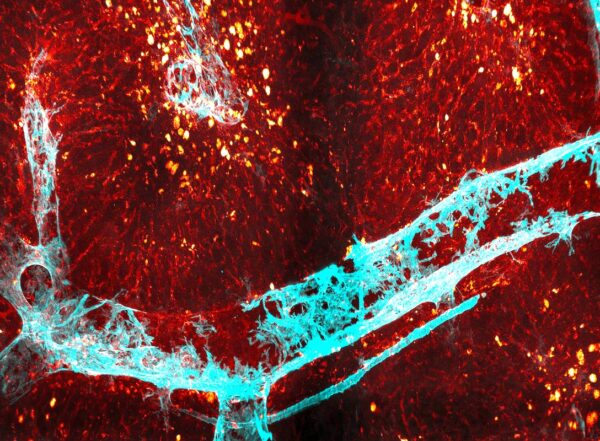 a tissue section of a damaged liver