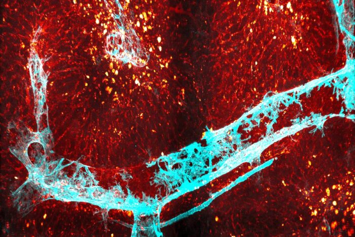 a tissue section of a damaged liver