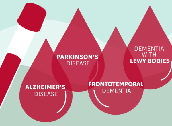 Illustration showing a vial of blood and four overlapping blood drops labeled Alzheimer's disease, Parkinson's disease, frontotemporal dementia, and dementia with Lewy bodies.