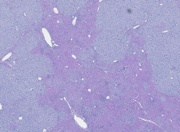 Mouse liver modeling alpha1-antitrypsin deficiency