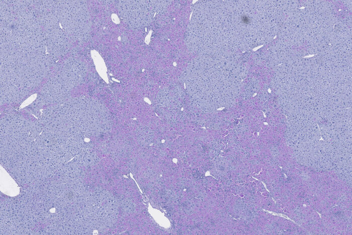 Mouse liver modeling alpha1-antitrypsin deficiency