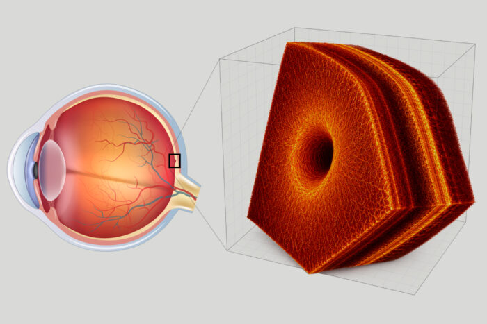 an eyeball with a zoomed out image of a piece of the retina shown on an OCT scan